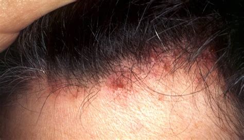 How To Treat Scabs On The Scalp