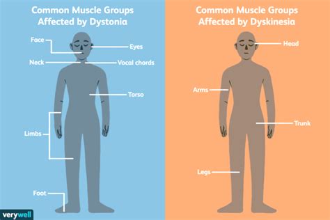 Dyskinesia: Symptoms, Causes, Diagnosis, and Treatment