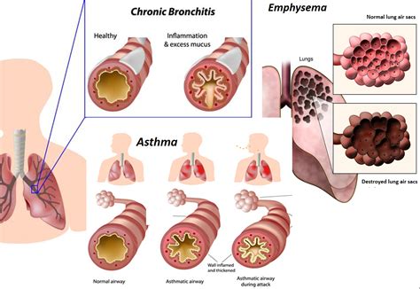 Asthma And Bronchitis Are Common Respiratory Conditions Drvarsha