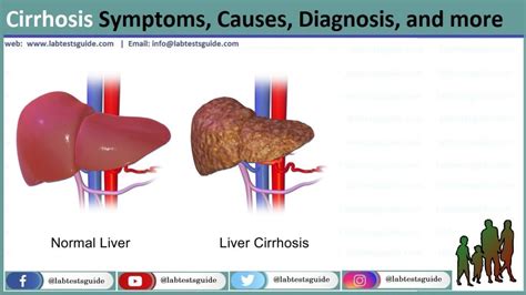 Cirrhosis Symptoms Causes Diagnosis And More Lab Tests Guide