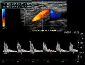 External-carotid-artery-ultrasound - Vascular Medicine - Angiologist