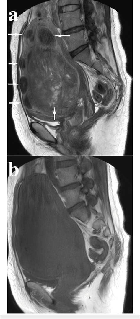 Pdf Pseudo Meigs Syndrome In A Patient With Uterine Fibroids With