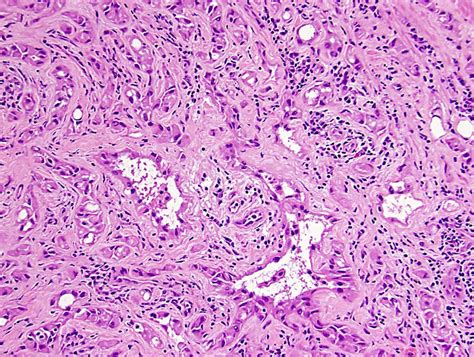 Pathology Outlines Adenomatoid Tumor