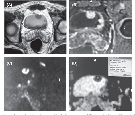 Figure 2 From The Role Of Diffusion Weighted Magnetic Resonance Imaging