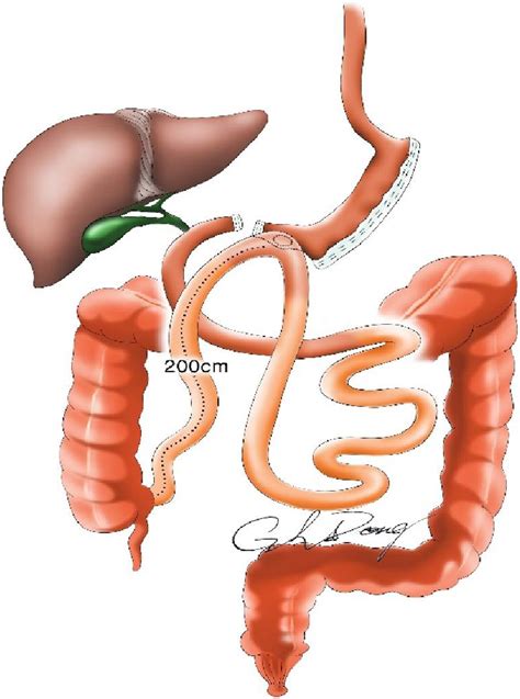 Single Anastomosis Duodeno Ileal Bypass With Sleeve Gastrectomy Sadi S