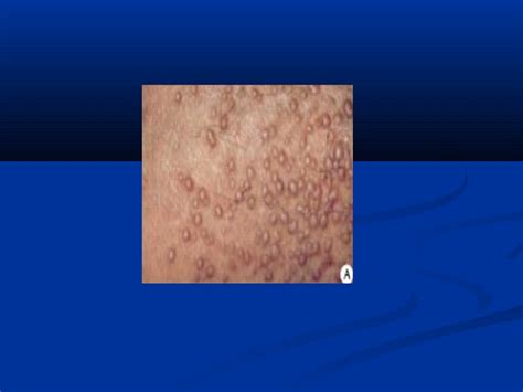 Lésions élémentaires En Dermatologie