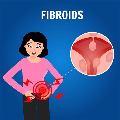 Premium Vector Infographic Of Fibroids In Vector Illustration