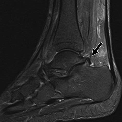 Mri Of Ankle And Lateral Hindfoot Impingement Syndromes Ajr