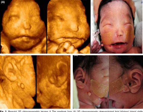 Bilateral Cleft Lip Ultrasound