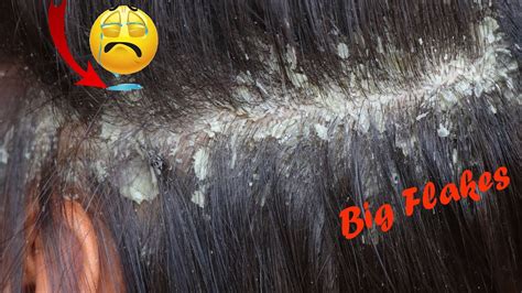 Dandruff Scratching Big Flakes No Talking Dandruff Removal Youtube