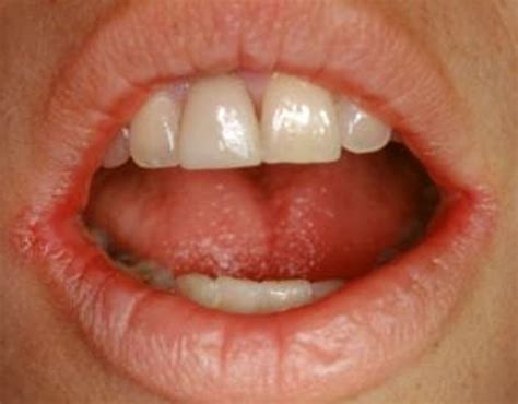 Angular Cheilitis - Pictures, Treatment, Symptoms, Causes | HubPages