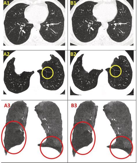 Quantitative Computed Tomography Ct Of The Chest Before