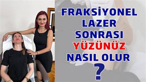 Fraksiyonel Lazer Sonrası Yüzünüz Nasıl Olur YouTube