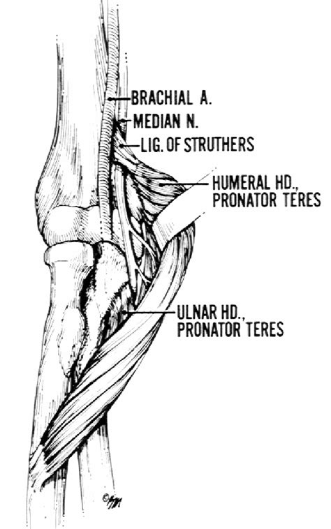 Pronator Syndrome Semantic Scholar