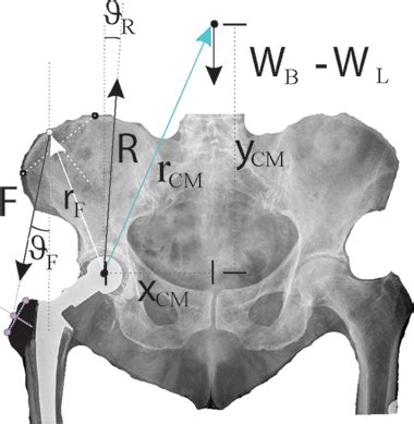 Understanding Hip Biomechanics From Simple Equilibrium To Personalized