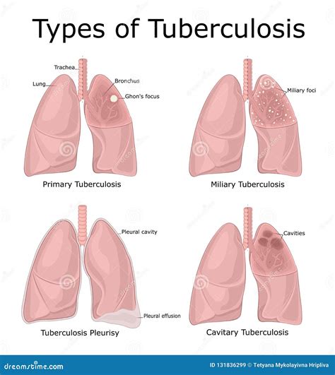 Tuberculose Stock Illustrations Vecteurs And Clipart 2929 Stock