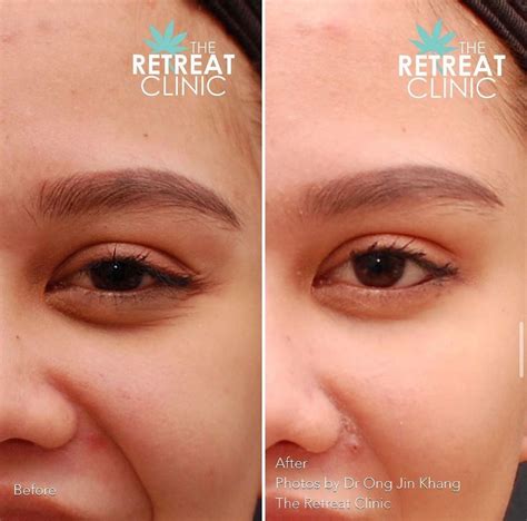 Botox Before After Aesthetic Clinic In Shah Alam Malaysia