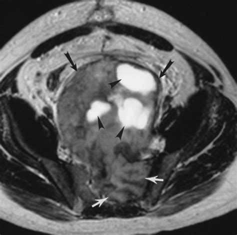 Cross Sectional Imaging Of Peripheral Nerve Sheath Tumors