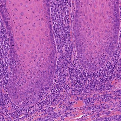 Condylomata Lata Of The Oral Commissure An Unexpected Presentation Of Secondary Syphilis