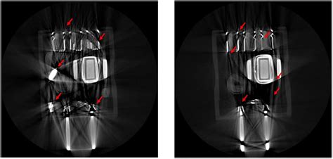 How To Recognize Ct Artifacts And Minimize Them During Data Collection