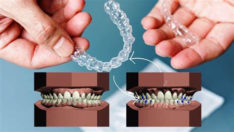 What Are Attachments In Clear Aligner Treatment?