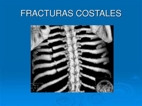 FRACTURA COSTAL Cirugia De Columna En Matamoros