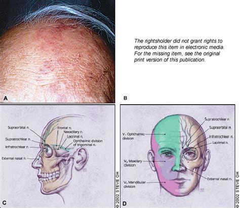 Evaluation And Management Of Herpes Zoster Ophthalmicus Aafp