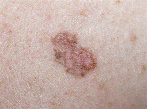 Do You Know The 7 Warning Signs Of Skin Cancer