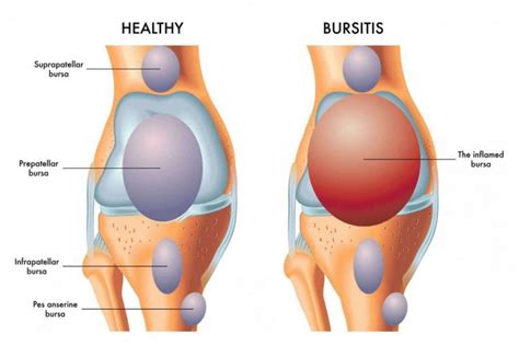 Bursite Du Genou Sympt Mes Causes Traitement Par Les Genouill Res