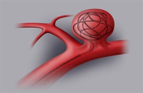 Cerebral Aneurysm Symptoms And Diagnosis Scope Heal