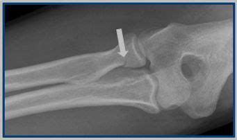 Radial Head/Neck Fracture | Bayside Hand Therapy