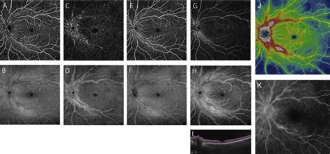 Retinal Vasculitis