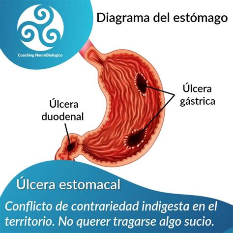 Lcera Estomacal Coaching De Salud Integral