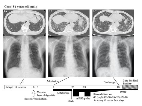 Cystic Fibrosis Lungs Vs Healthy Lungs