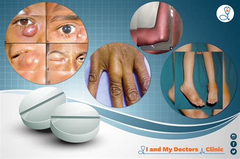 Abscess | Call 2813035678 | I and My Doctors Clinic