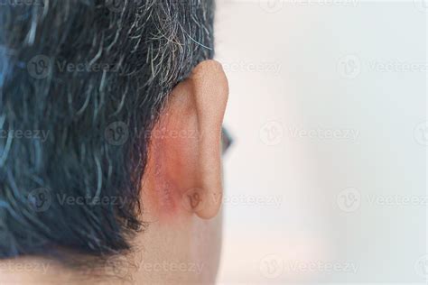 Man Having Ear Problems Due To Seborrheic Dermatitis Psoriasis Ringworm And Fungal Skin