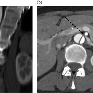 Preoperative Computed Tomography Scan Images Showing Compression Of The