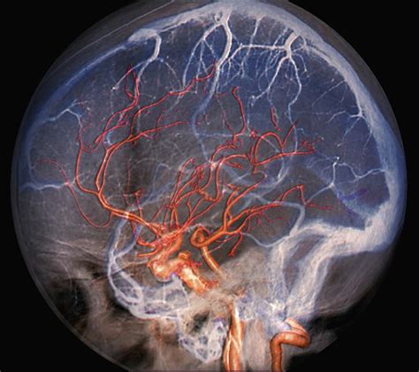 Brain Blood Vessels Photograph By Zephyr Science Photo Library