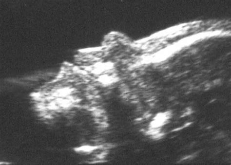 Nasal Bone Hypoplasia In Trisomy At Weeks Gestation Cicero