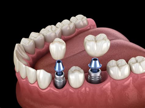 What Are Dental Implants Made Of Creekview Dental