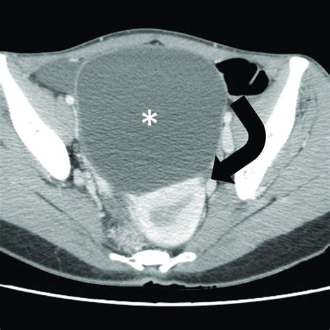 A 58 Year Old Woman With Right Ovarian Mucinous Cystadenoma Axial