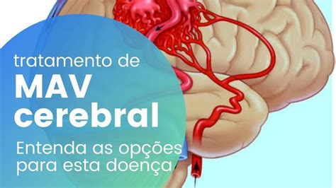 Tratamento De Mav Cerebral Youtube