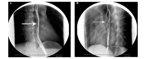 Esophageal Metastasis Secondary To Extranodal Nasal Type Natural Killer