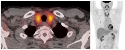 Imaging Findings Of Immune Related Thyroiditis On Fdg Pet Ct