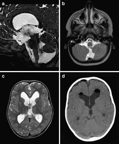 Ac Preoperative Sagittal A And Axial B C T2 Weighted MR Images