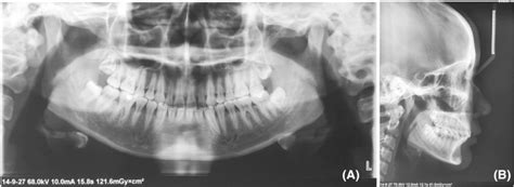 Posttreatment Panoramic And Lateral Cephalometric Radiographs