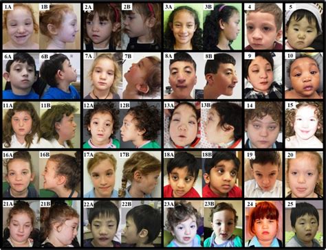 CDK13-Related Disorder - GeneReviews® - NCBI Bookshelf 