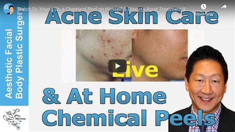 Acne Topical Medication Seattle And Bellevue