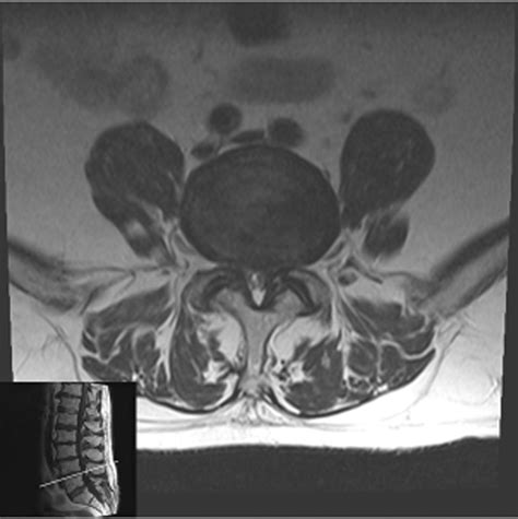 Lateral Lumbar Interbody Fusion Clinical Tree