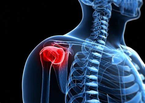 Shoulder Arthritis Shoulder Specialist Austin Round Rock Cedar